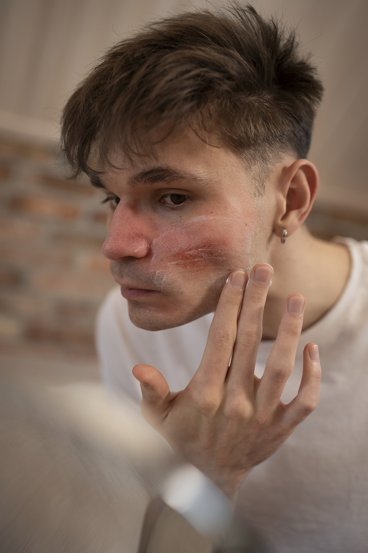 How to Tackle Common Skin Concerns: Acne, Dryness, and Hyperpigmentation
